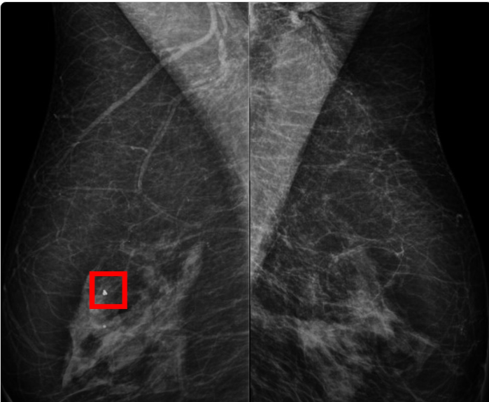 Poder informar que mamografia causa câncer médico é condenado
