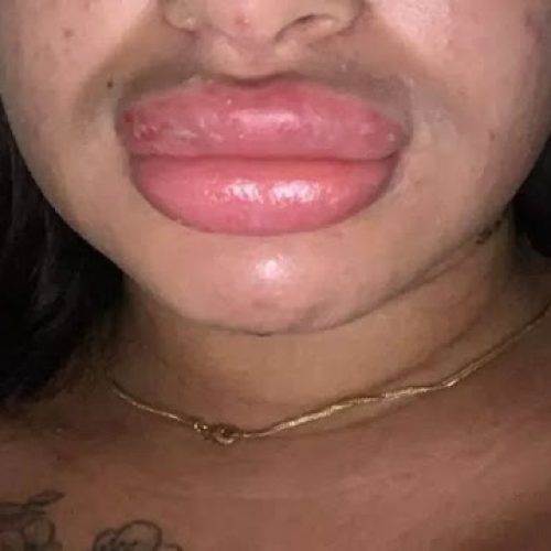 Oferecia corpo dos sonhos: Após deformar ao menos 30 pacientes, biomédica some das redes sociais