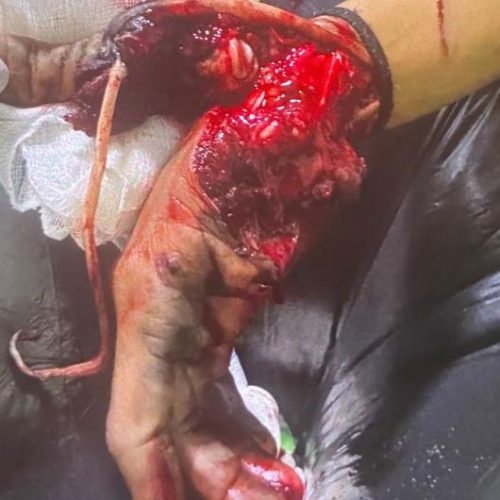 Jovem sofre grave acidente durante guerra de espadas em Cruz das Almas