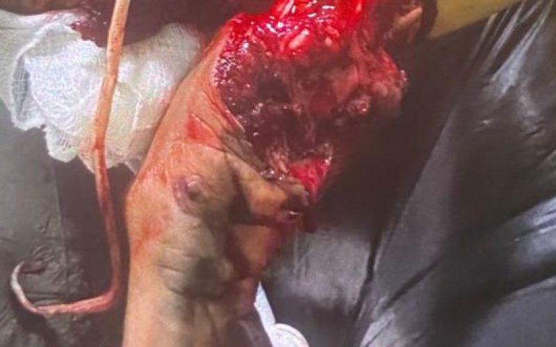 Jovem sofre grave acidente durante guerra de espadas em Cruz das Almas