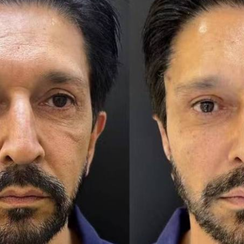 Ricardo Nunes faz harmonização facial; veja o antes e depois