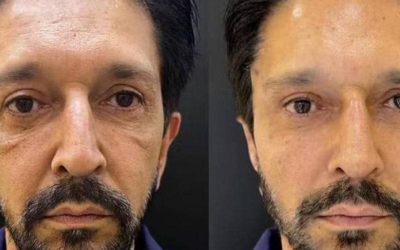 Ricardo Nunes faz harmonização facial; veja o antes e depois
