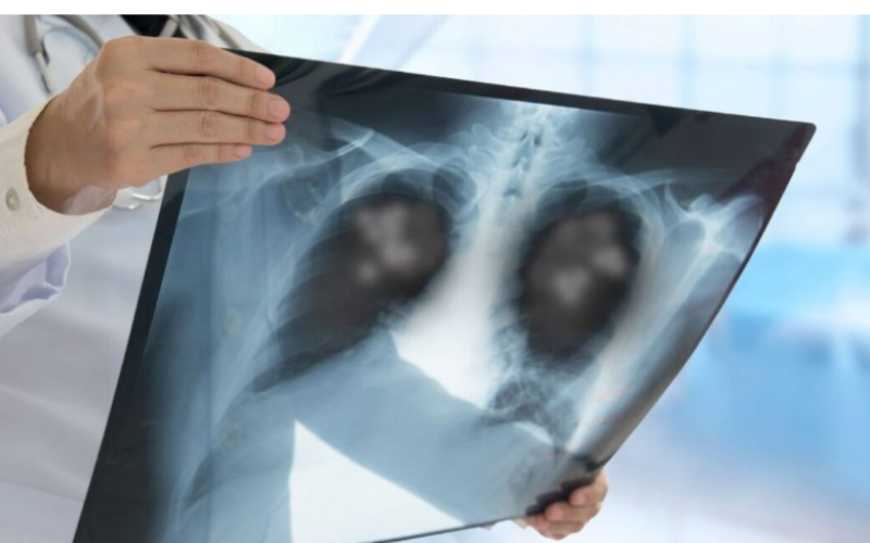 Cerca de 11 pessoas morrem diariamente por pneumonia na Bahia, alerta Sesab