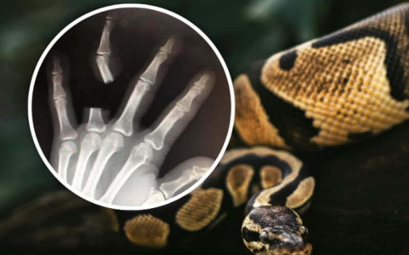Homem é picado por cobra corta o dedo e ao chegar no hospital descobre que a cobra não era venenosa