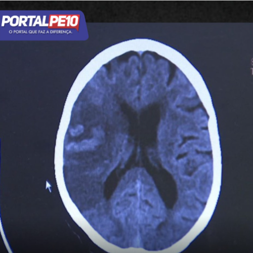 ACV mata 1 Brasileiro a cada 6 minutos
