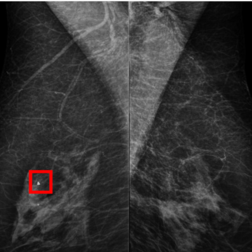 Poder informar que mamografia causa câncer médico é condenado