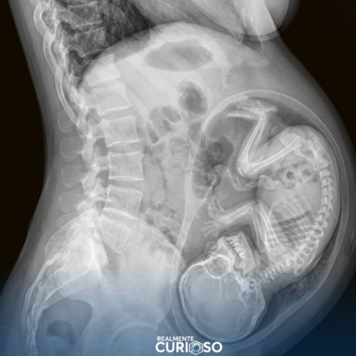 Cálcio que o bebê usa para formar seus ossos vem diretamente da circulação materna