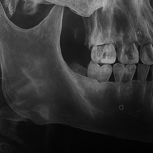 Problemas dentários pode esta por trás de AVC e enfarto