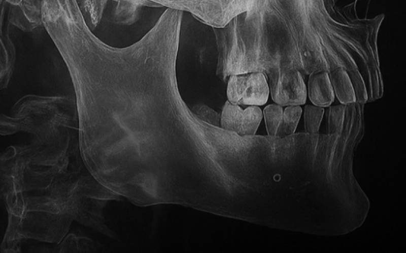 Problemas dentários pode esta por trás de AVC e enfarto