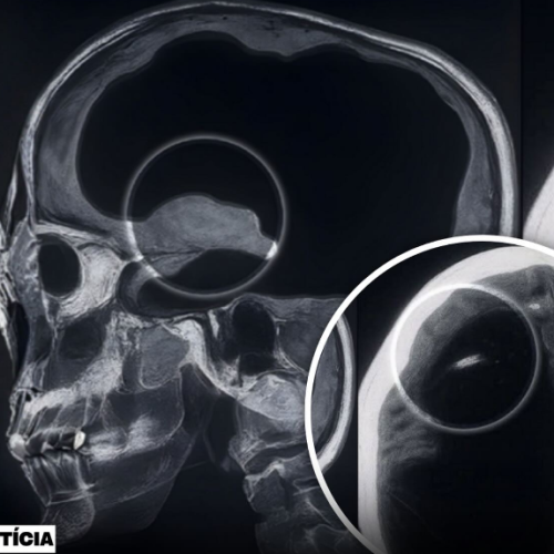 Homem descobre que viveu a vida inteira com apenas 10% do cerebro