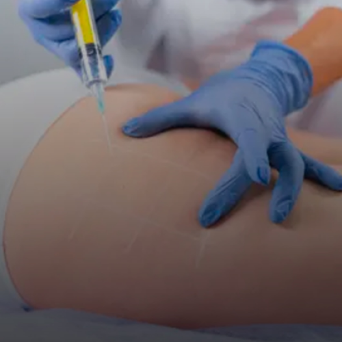 Nova técnica estética que utiliza gordura humana de doadores falecidos para preenchimentos corporais tem ganhado espaço em clínicas