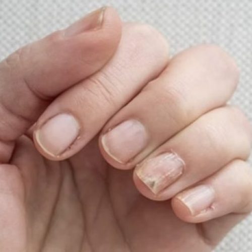 Mudança nas unhas faz paciente descobrir câncer