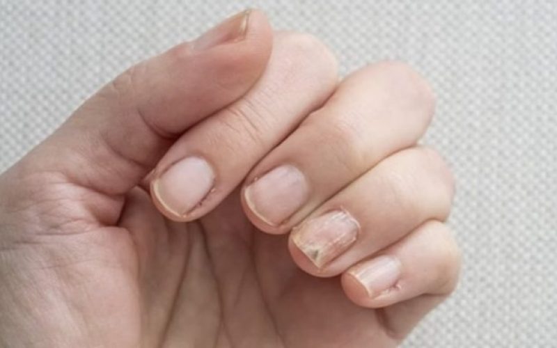 Mudança nas unhas faz paciente descobrir câncer